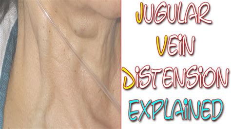 What Is Jugular Vein Distention | Something In About 5 Minutes | Medic ...