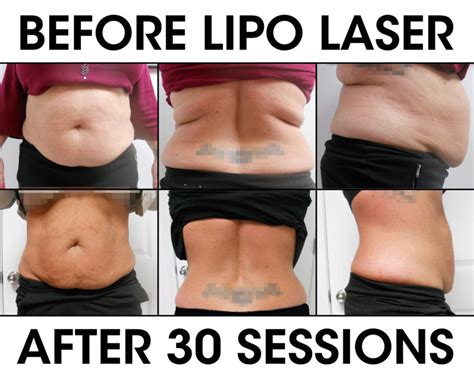 Lipo Laser Weight Loss - Liberation Chiropractic & Wellness