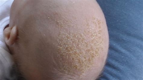 Is It Baby Acne, or Rash, or Something Else?