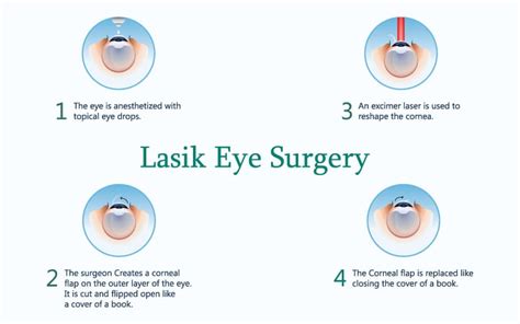 lasik-process | Sibia Eye Institute