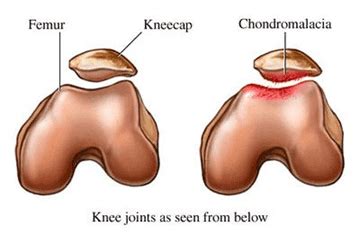 Chondromalacia Patella - Mississauga Chiropractor and Physiotherapy Clinic - FREE Consult!