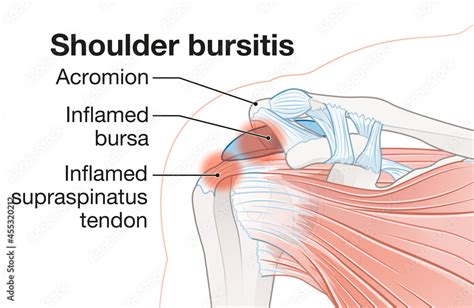 Shoulder bursitis. Inflamed bursa and supraspinatus tendon Stock ...