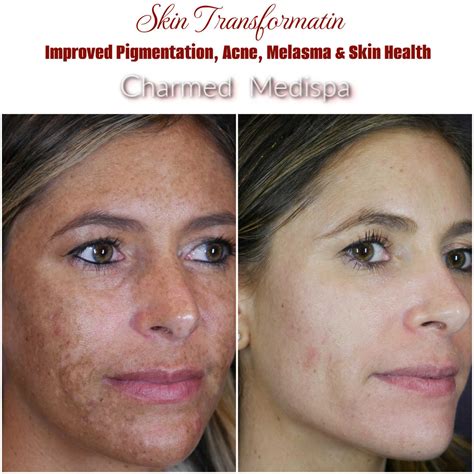 Skin Damage, Acne, Pigmentation And Skin Health ZO Skin Health Solutions – Charmed Medispa