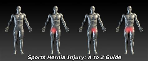 Sports Hernia Testicular Pain - slidesharetrick