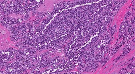 Medullary thyroid carcinoma | Atlas of Pathology