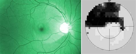 Nerve Fiber Layer Defects Imaging in Glaucoma | IntechOpen