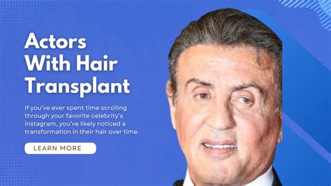 Actors With Hair Transplant: 8 Celebrities Before&After