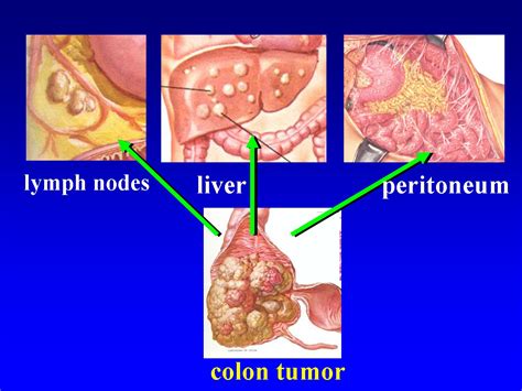 Stage Iib Squamous Cell Carcinoma Of The Cervix Icd 10