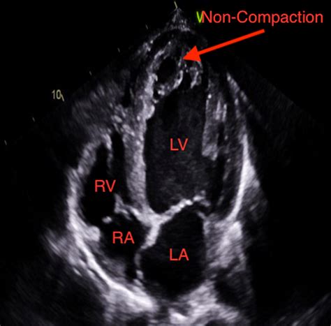 Cureus | Heart Failure Secondary to Left Ventricular Non-compaction Cardiomyopathy in a 26-Year ...