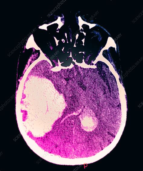 Massive Intracranial Hemorrhage, CT Scan - Stock Image - C027/1773 - Science Photo Library