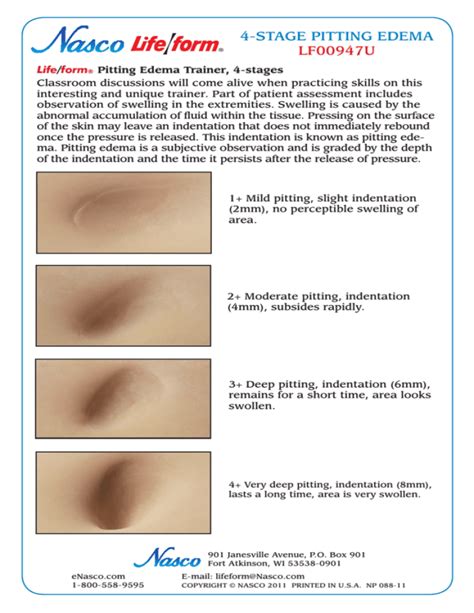 4-STAGE PITTING EDEMA LF00947U