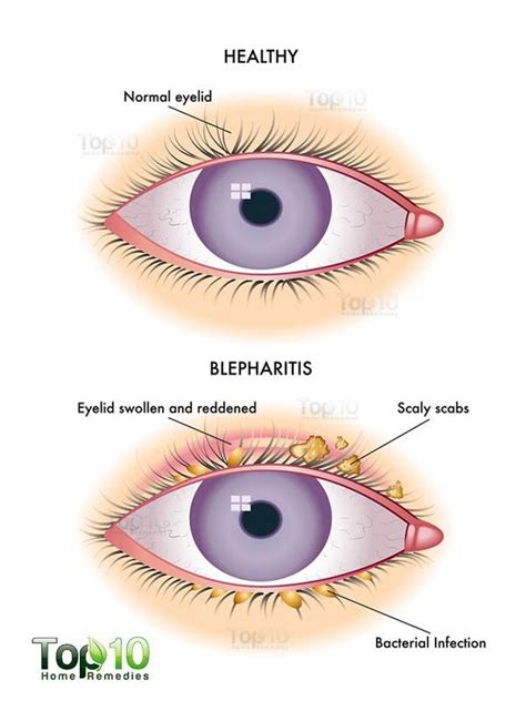 Home Remedies for Blepharitis (Eyelid Inflammation) | Top 10 Home Remedies