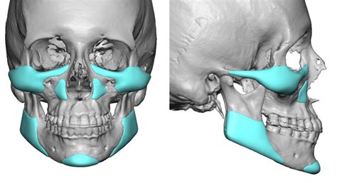 Custom Jaw Implants - Chin Implants | Eppley Custom Facial Implants