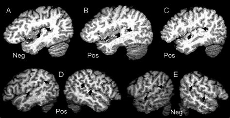 MRI images of Heschl’s gyrus ( top ) and the planum temporale ( bottom... | Download Scientific ...