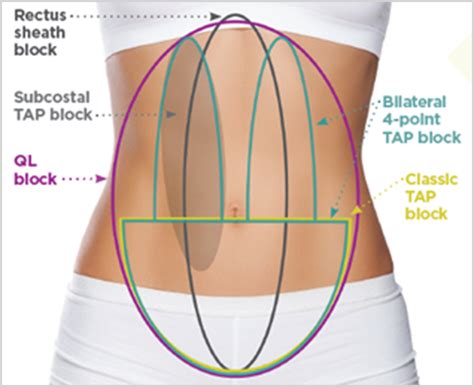 ABDOMINAL, TAP & PEC INFILTRATION