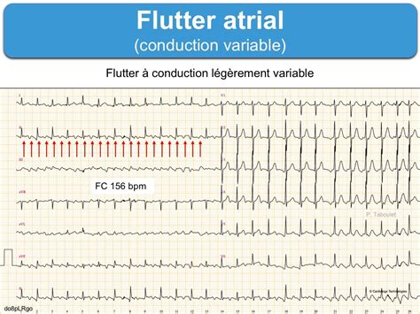 Typical Atrial Flutter Ekg