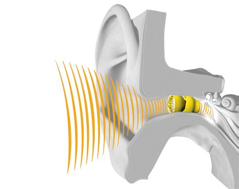 Lyric changes lives - the first 100% invisible extended wear hearing aid - North London Hearing