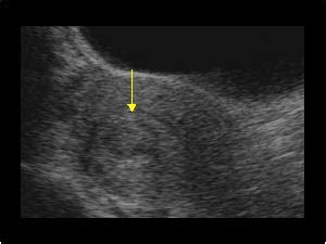 Gynaecology | 3.1 Uterus : Case 3.1.1 Uterine fibroids | Ultrasound Cases