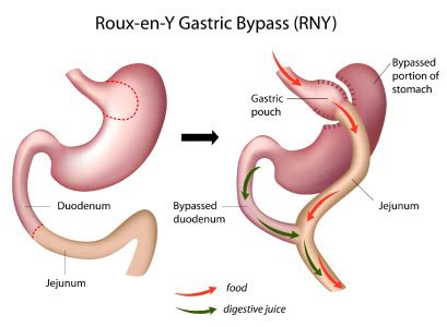 Roux-en-Y Gastric Bypass (RYGB) | UI Health