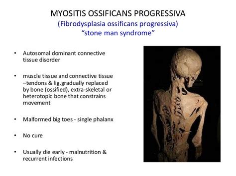 Post traumatic myositis ossificans dr. k. prashanth