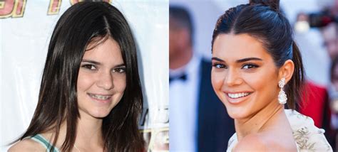 Orthodontics Australia | 6 Celebrities With Braces Before and After — Wonderful Transformations