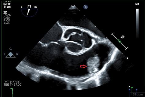 Asymptomatic Pulmonic Valve Mass: A Diagnostic and Therapeutic Dilemma ...