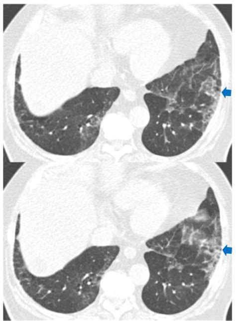 Figure 2 from Traction Bronchiectasis/Bronchiolectasis is Associated with Interstitial Lung ...