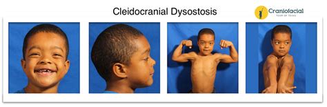 Cleidocranial-Dysostosis - Dell Children's Craniofacial Team of Texas