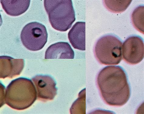 Image: Malarial parasites, Plasmodium species, ring forms in red blood cells