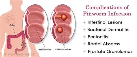 Pinworm | Thread worm Infection - Causes, Symptoms, Diagnosis ...