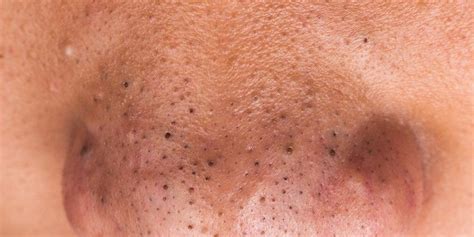 How to Get Rid of Blackheads on Your Nose | Men’s Health