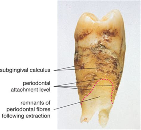 4: Clinical Examination and Local Risk Factors for Periodontal Diseases | Pocket Dentistry