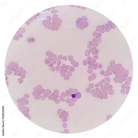 Reticulocyte count under 100x light microscope by using New methylene ...