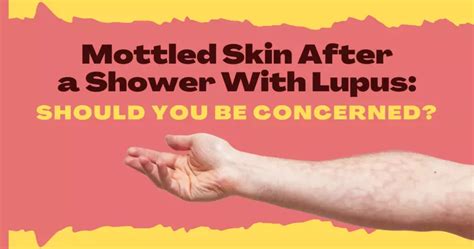 Mottled Skin After a Shower With Lupus: Should You Be Concerned? | MyLupusTeam