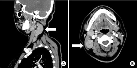 Ct Scan Neck Lymph Nodes