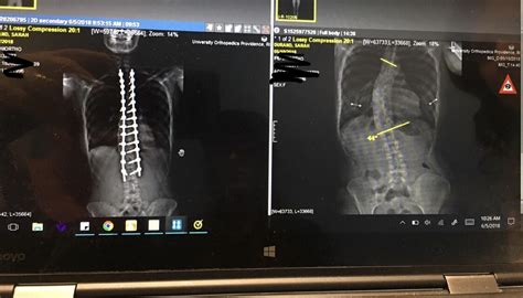 Before and after corrective spinal surgery. Link in comments with few ...