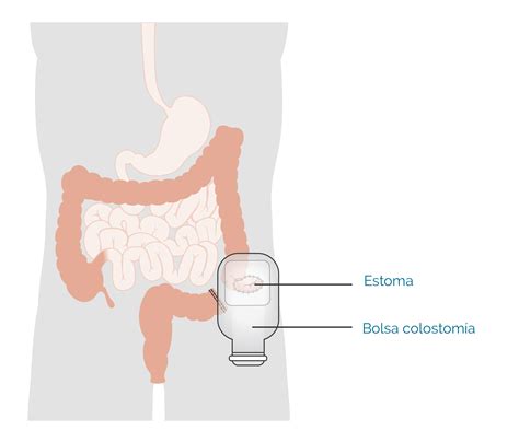 Estoma-bolsa-colostomia - Miss Bowel