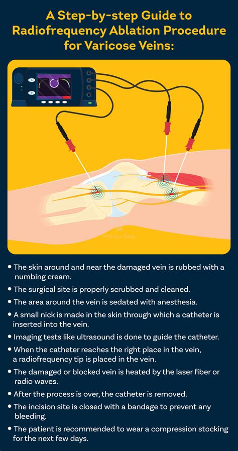 Radiofrequency Ablation (RFA) for Varicose Veins: Procedure ...