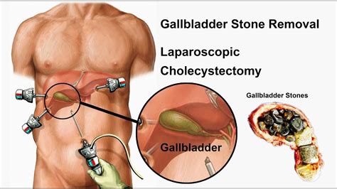 Gallbladder Stone Surgery in Jaipur India by Dr. Sundeep Jain