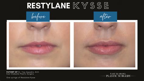 Juvederm | Restylane - Auburn Med Spa