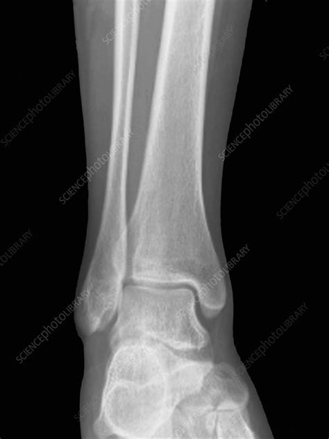 Normal ankle joint, X-ray - Stock Image - F002/7554 - Science Photo Library