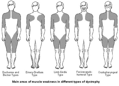 How Much Do You Know About Muscular Dystrophy (MD)? | Novacorr Healthcare