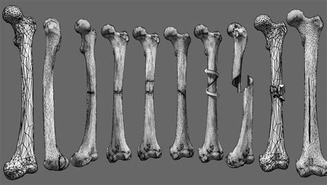 FRYKMAN CLASSIFICATION OF Radiology Classroom Facebook, 48% OFF