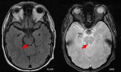 Fourth nerve palsy – Case-Based Neuro-Ophthalmology