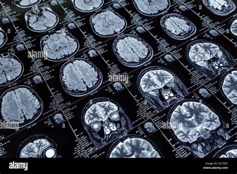 X-ray image of human brain Stock Photo - Alamy