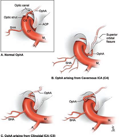 Ophthalmic Artery Aneurysms | Neupsy Key