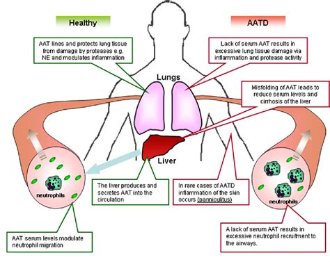 Alpha-1 Antitrypsin: A Potent Anti-Inflammatory and Potential Novel Therapeutic Agent | Semantic ...