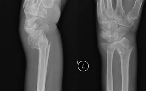 emDOCs.net – Emergency Medicine EducationUltrasound-Guided Hematoma Block - emDOCs.net ...