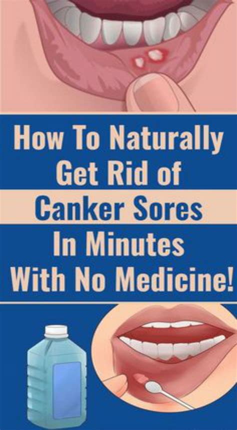 How to cure canker sores and mouth sores? - healthpinspopular