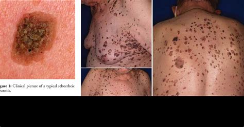 Understanding Seborrheic Keratosis (SK): Causes Symptoms And Treatments ...